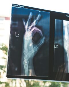 Photo of an X-ray showing a hand.